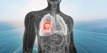 Un ensayo liderado por el Hospital Puerta de Hierro ofrece resultados esperanzadores al reducir recaídas en cáncer de pulmón
